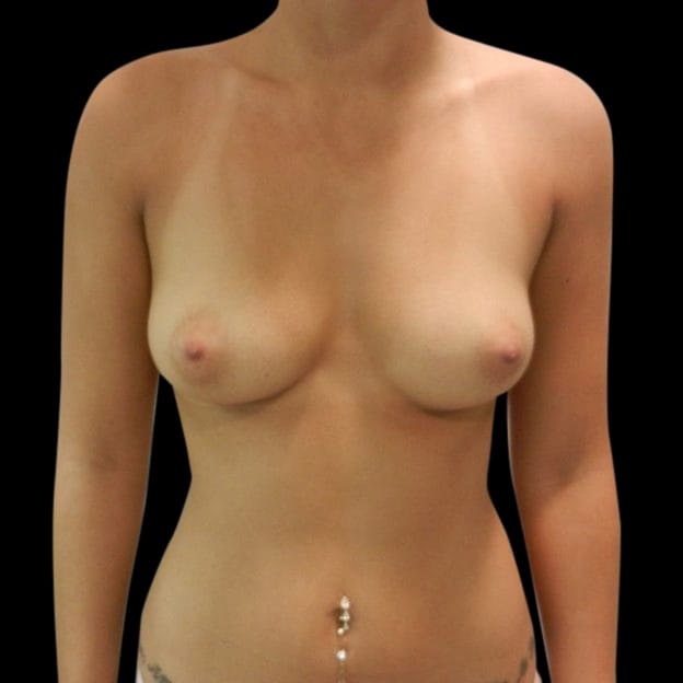 Breast Augmentation Before & After Gallery - Patient 58232396 - Image 1