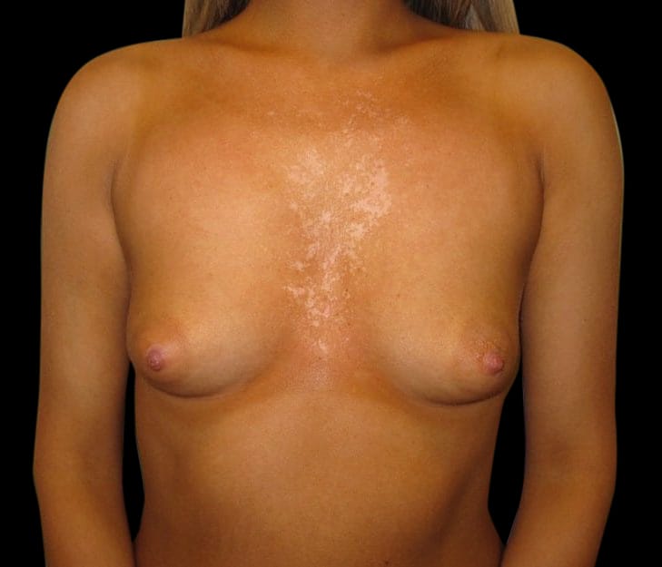 Breast Augmentation Before & After Gallery - Patient 58232406 - Image 1