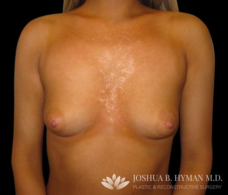 Breast Augmentation Before & After Gallery - Patient 58232406 - Image 1