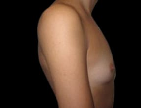 Breast Augmentation Before & After Gallery - Patient 58232284 - Image 1