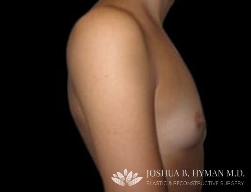 Breast Augmentation Before & After Gallery - Patient 58232284 - Image 1