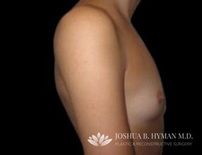 Breast Augmentation Before & After Gallery - Patient 58232284 - Image 1