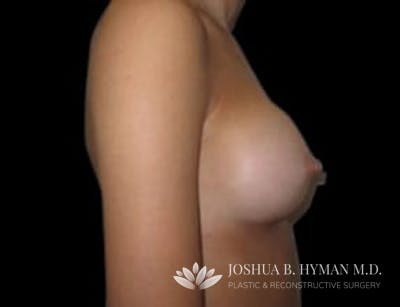 Breast Augmentation Before & After Gallery - Patient 58232284 - Image 2