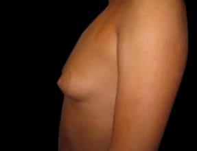 Breast Augmentation Before & After Gallery - Patient 58232286 - Image 1
