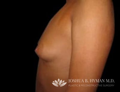 Breast Augmentation Before & After Gallery - Patient 58232286 - Image 1