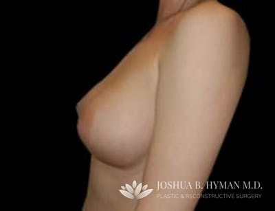 Breast Augmentation Before & After Gallery - Patient 58232286 - Image 2