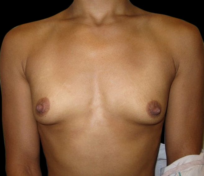 Breast Augmentation Before & After Gallery - Patient 58232426 - Image 1