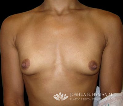 Breast Augmentation Before & After Gallery - Patient 58232426 - Image 1