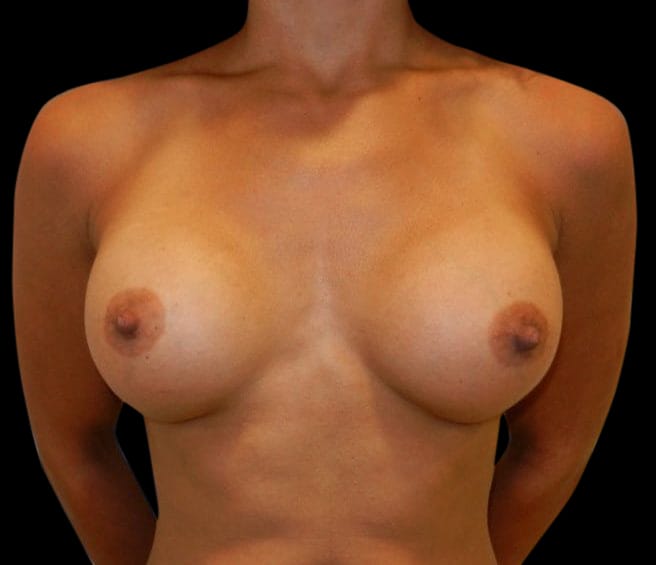 Breast Augmentation Before & After Gallery - Patient 58232426 - Image 2
