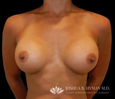 Breast Augmentation Before & After Gallery - Patient 58232426 - Image 2