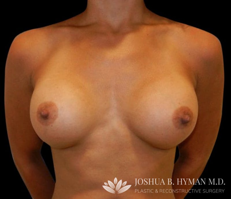 Breast Augmentation Before & After Gallery - Patient 58232426 - Image 2