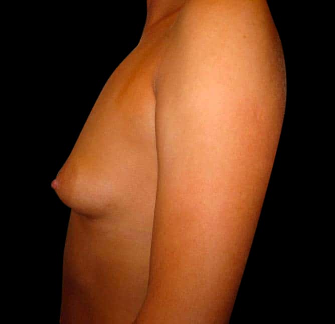 Breast Augmentation Before & After Gallery - Patient 58232431 - Image 1