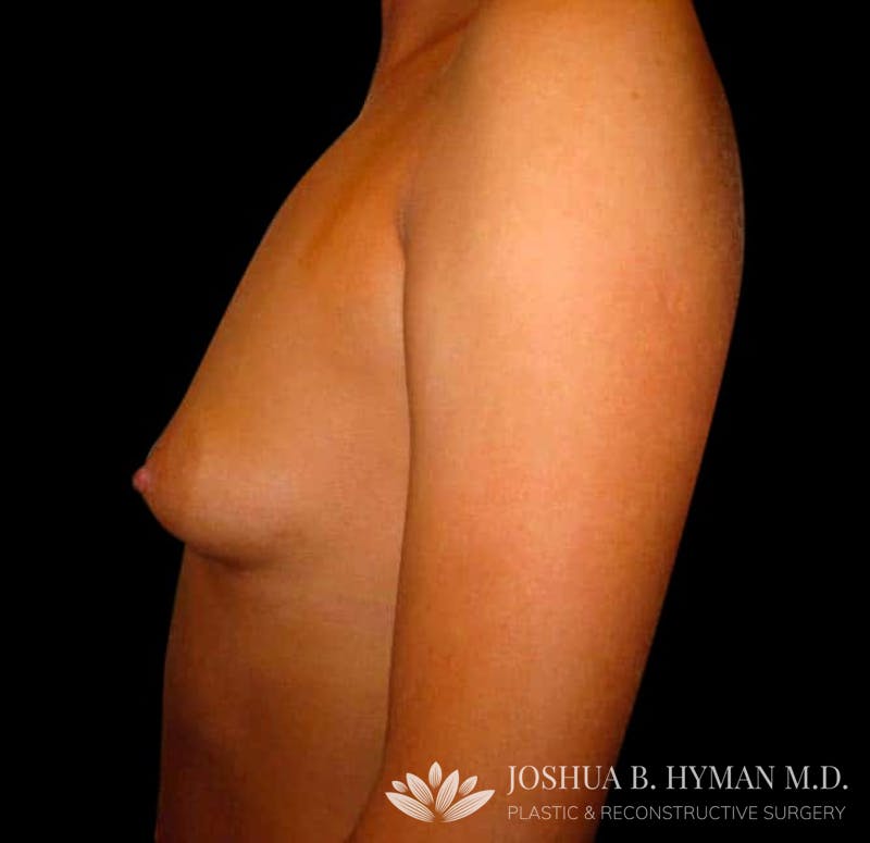 Breast Augmentation Before & After Gallery - Patient 58232431 - Image 1