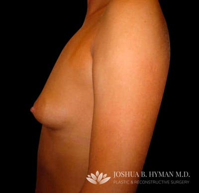 Breast Augmentation Before & After Gallery - Patient 58232431 - Image 1