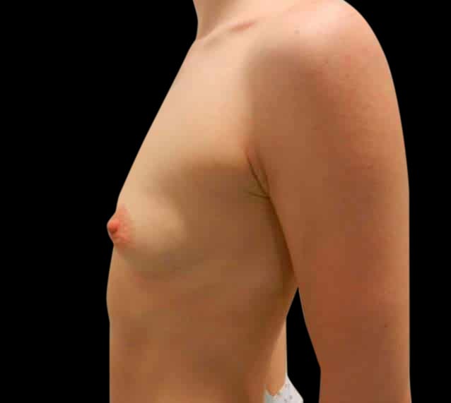 Breast Augmentation Before & After Gallery - Patient 58232432 - Image 1