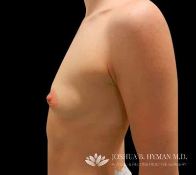 Breast Augmentation Before & After Gallery - Patient 58232432 - Image 1