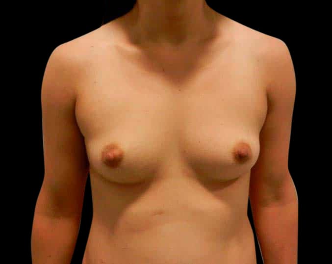 Breast Augmentation Before & After Gallery - Patient 58232433 - Image 1