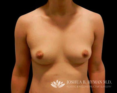 Breast Augmentation Before & After Gallery - Patient 58232433 - Image 1