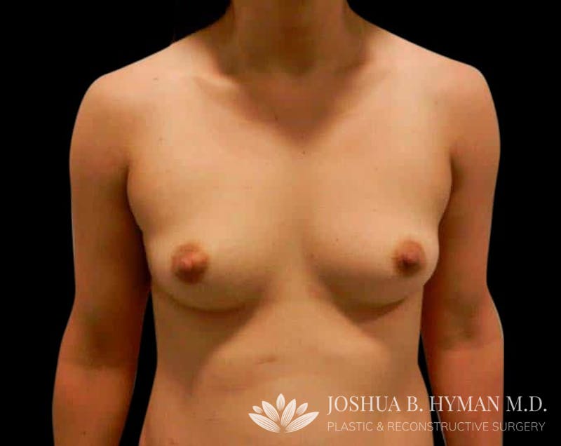Breast Augmentation Before & After Gallery - Patient 58232433 - Image 1