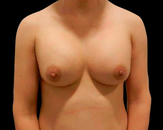 Breast Augmentation Before & After Gallery - Patient 58232433 - Image 2