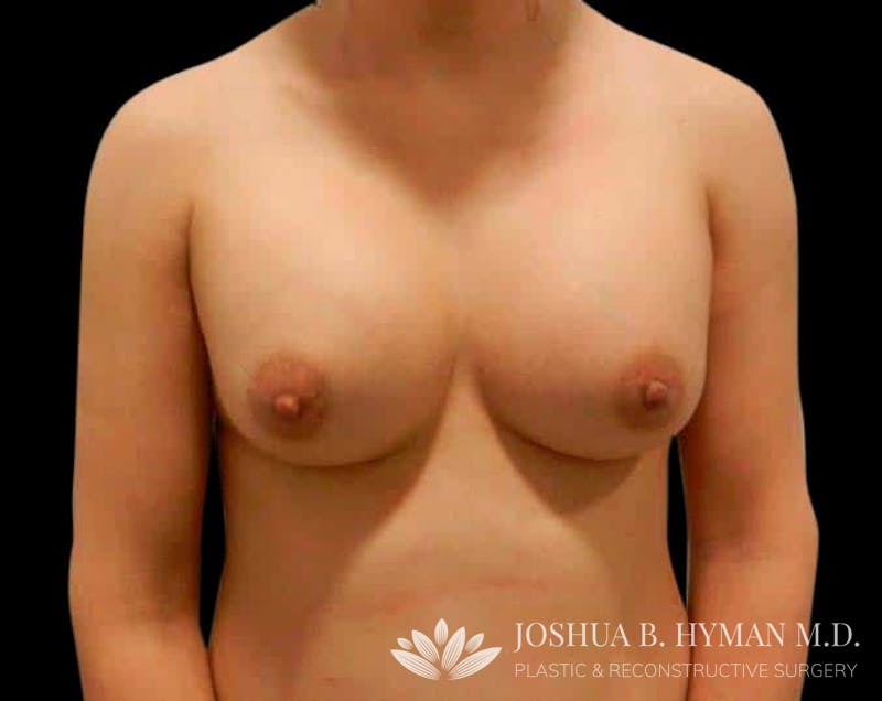 Breast Augmentation Before & After Gallery - Patient 58232433 - Image 2
