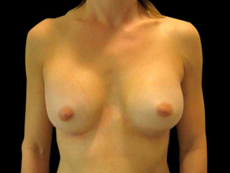 Breast Augmentation Before & After Gallery - Patient 58232434 - Image 2