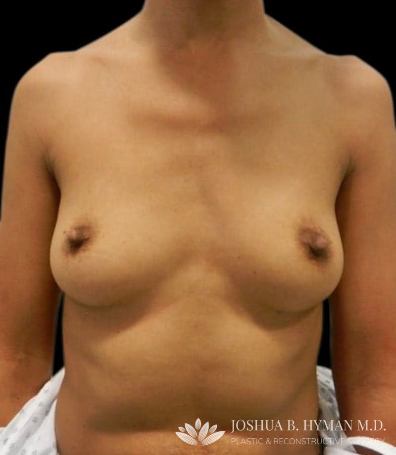 Breast Augmentation Before & After Gallery - Patient 58232440 - Image 1