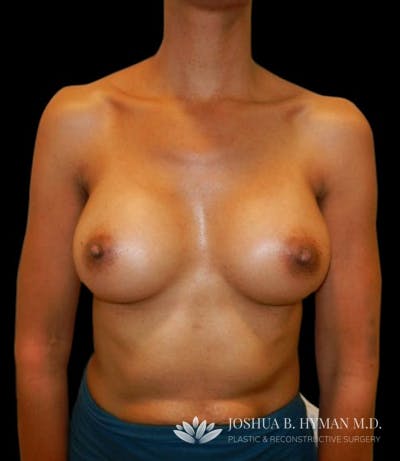 Breast Augmentation Before & After Gallery - Patient 58232440 - Image 2