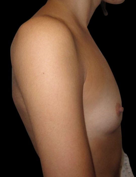 Breast Augmentation Before & After Gallery - Patient 58232442 - Image 1