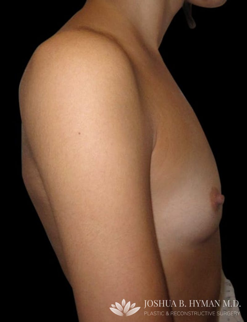 Breast Augmentation Before & After Gallery - Patient 58232442 - Image 1