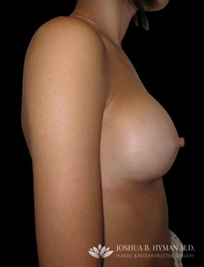 Breast Augmentation Before & After Gallery - Patient 58232442 - Image 2