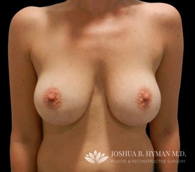Breast Augmentation Before & After Gallery - Patient 58232448 - Image 2
