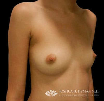 Breast Augmentation Before & After Gallery - Patient 58232459 - Image 1