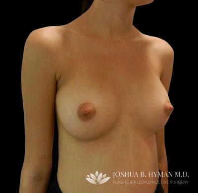 Breast Augmentation Before & After Gallery - Patient 58232459 - Image 2