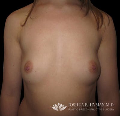 Breast Augmentation Before & After Gallery - Patient 58232463 - Image 1