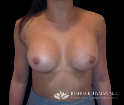 Breast Augmentation Before & After Gallery - Patient 58232465 - Image 2