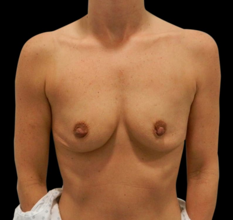 Breast Augmentation Before & After Gallery - Patient 58232467 - Image 1