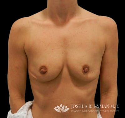 Breast Augmentation Before & After Gallery - Patient 58232467 - Image 1