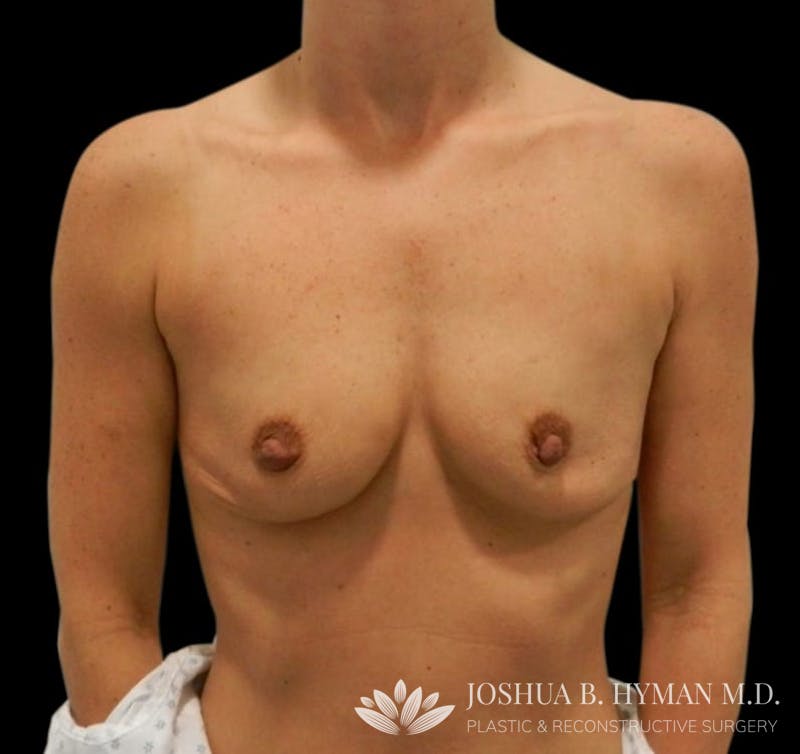 Breast Augmentation Before & After Gallery - Patient 58232467 - Image 1