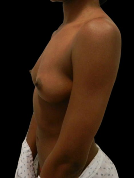 Breast Augmentation Before & After Gallery - Patient 58232476 - Image 3