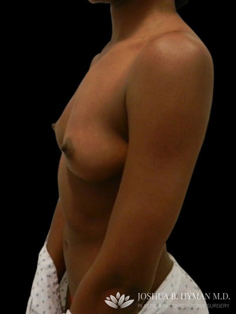 Breast Augmentation Before & After Gallery - Patient 58232476 - Image 3