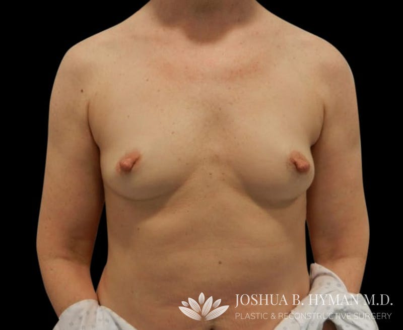 Breast Augmentation Before & After Gallery - Patient 58232497 - Image 1