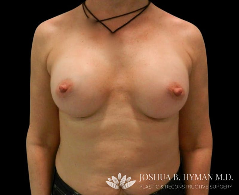Breast Augmentation Before & After Gallery - Patient 58232497 - Image 2