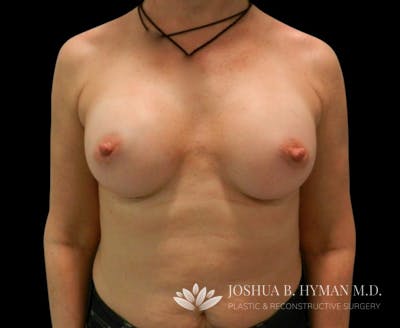Breast Augmentation Before & After Gallery - Patient 58232497 - Image 2