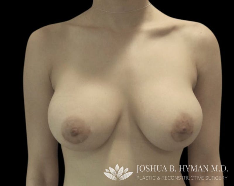 Breast Augmentation Before & After Gallery - Patient 58232596 - Image 2