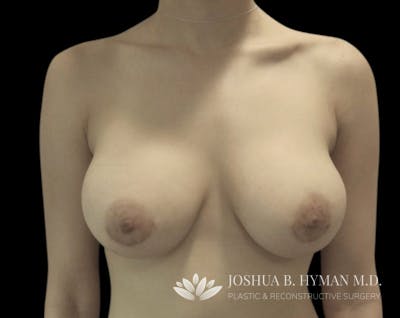 Breast Augmentation Before & After Gallery - Patient 58232596 - Image 2