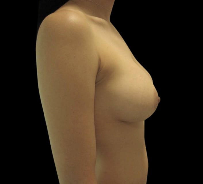 Breast Augmentation Before & After Gallery - Patient 58232596 - Image 4
