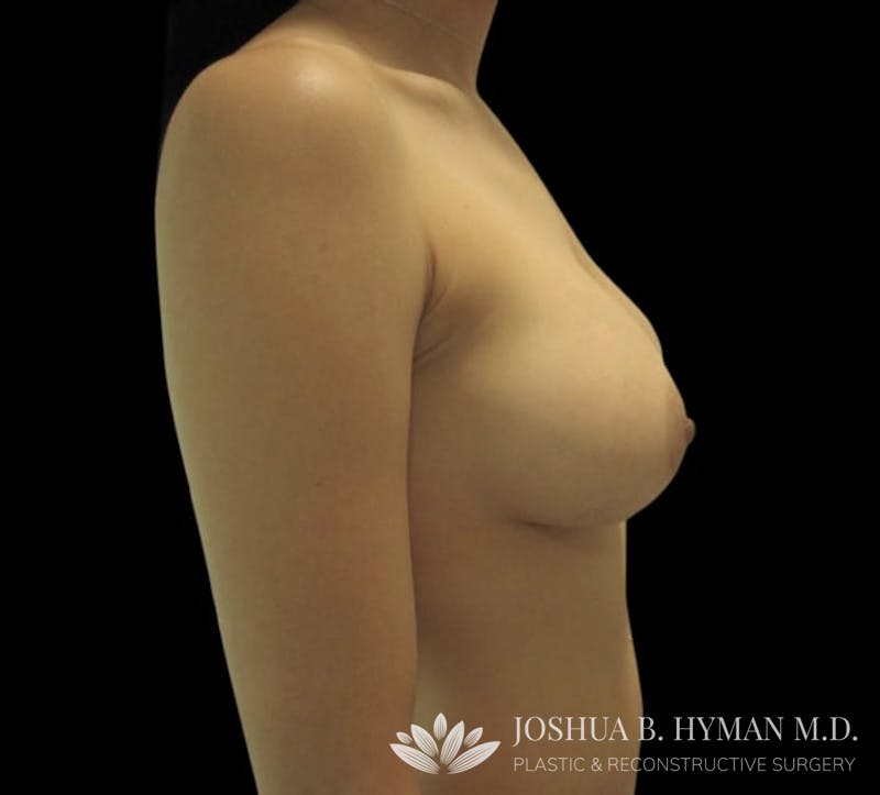 Breast Augmentation Before & After Gallery - Patient 58232596 - Image 4