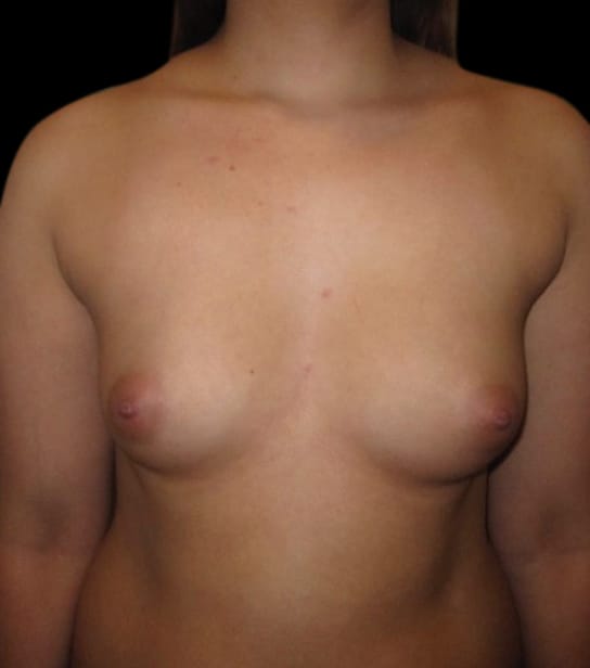 Breast Augmentation Before & After Gallery - Patient 58232628 - Image 1