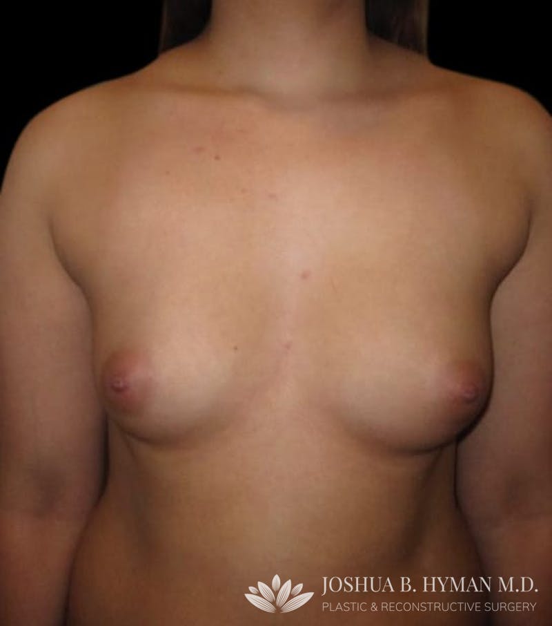 Breast Augmentation Before & After Gallery - Patient 58232628 - Image 1